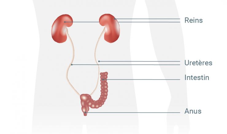Implantation urétéro-iléale: les uretères et un morceau détaché de la paroi rectale forment une vessie artificielle.