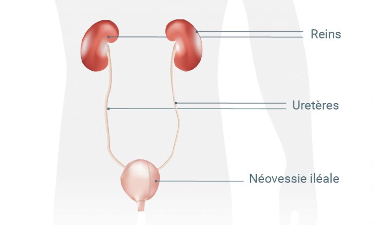 Urétérostomie cutanée: elle crée une communication directe entre les uretères et la paroi abdominale.