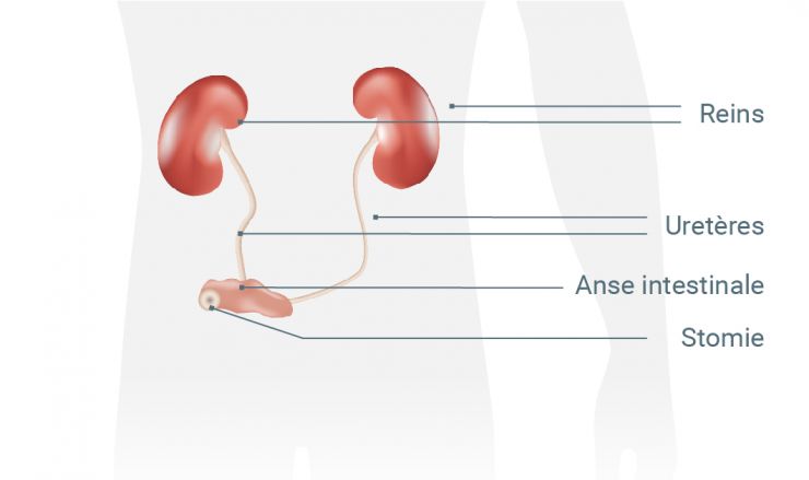 Urostomie: une sorte de canal d’écoulement conduit l’urine vers une stomie aménagée dans la paroi abdominale.